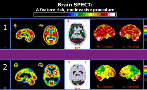 spect brain
